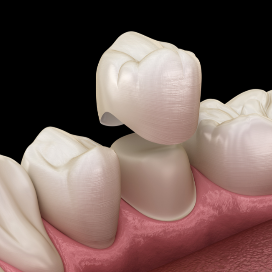 What Exactly Are Dental Crowns?