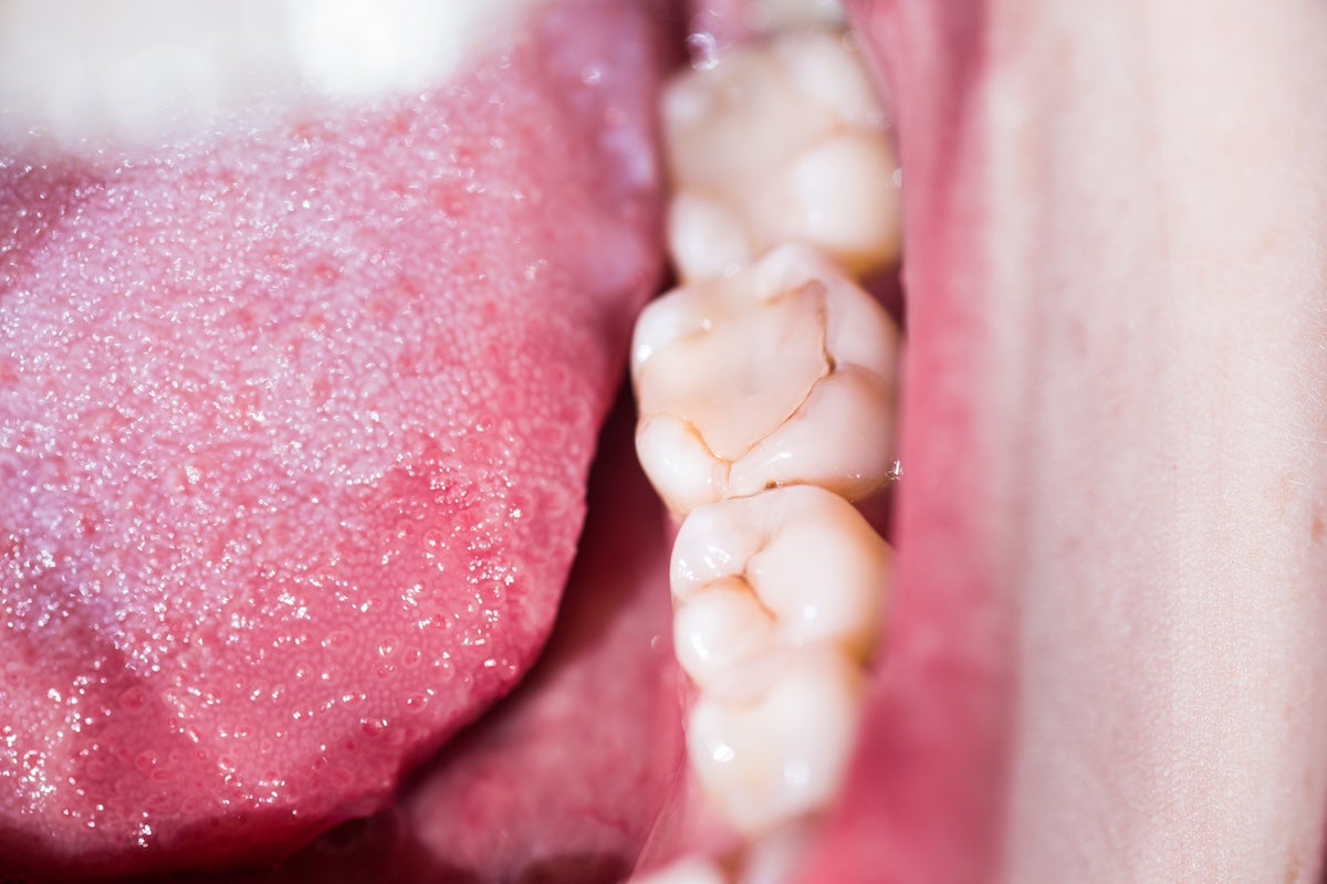 Signs that Your Dental Filling Is Going Bad