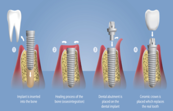 Implant