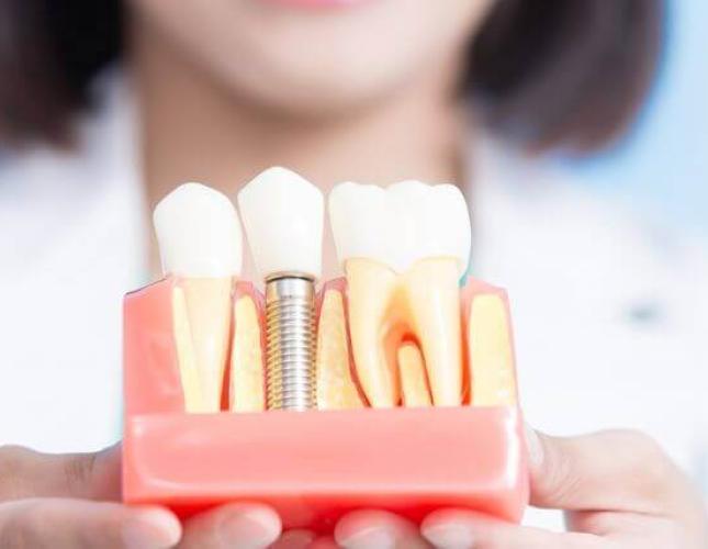 Addressing Failed Implants: Strategies for Successful Implant Restoration