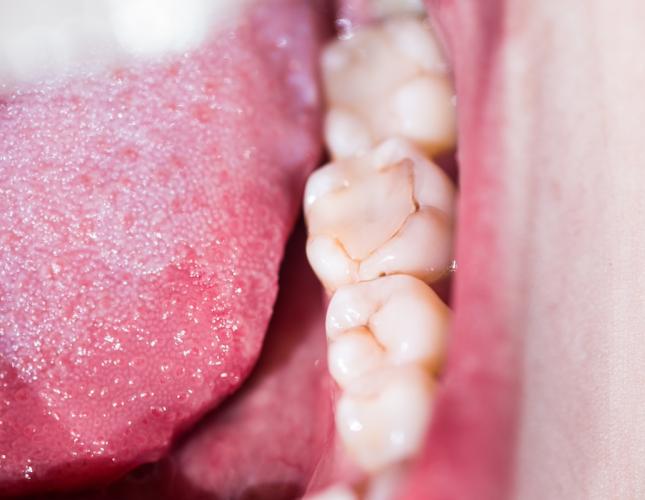3 Signs that Your Dental Filling Is Going Bad