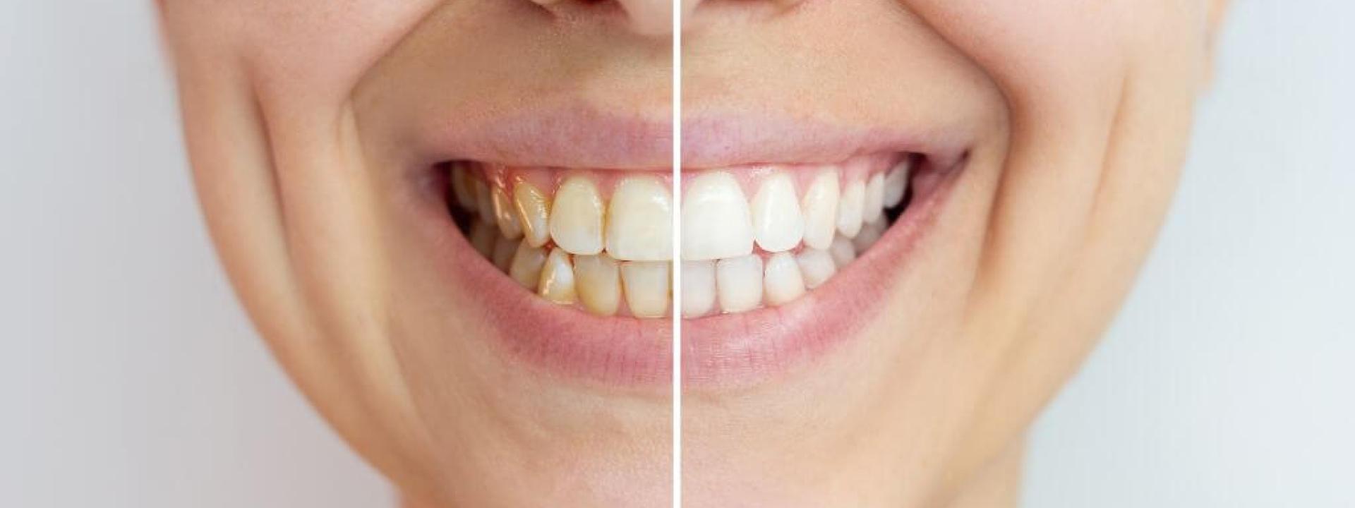Do Natural Teeth Whitening Remedies Really Work?